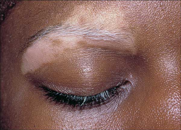 Scientists Unravel Causes Of Mysterious Skin Disease, Vitiligo 